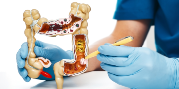 Bahia pode registrar mais de 2 mil novos casos de câncer colorretal em 2026, estima instituto